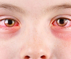 Ojos rojos y picazón, puede ser Conjuntivitis