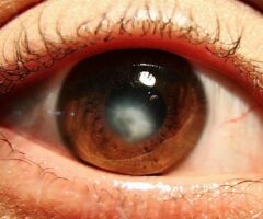 Leucoma corneal: ¿por qué es importante su diagnóstico temprano?